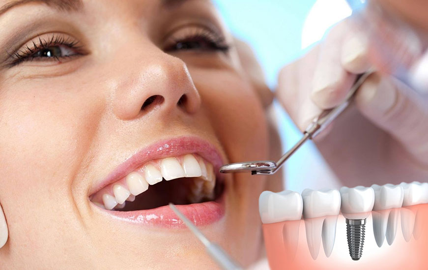 Implantes-dentales-como-saber-si-necesitas
